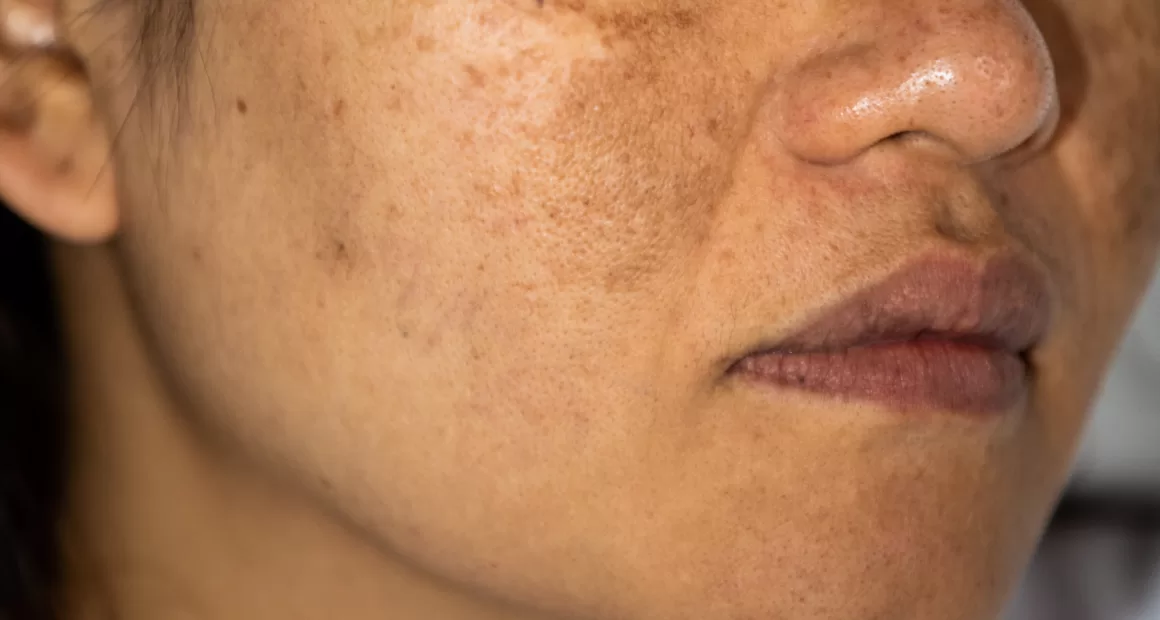 How To Get Rid of Pigmentation?