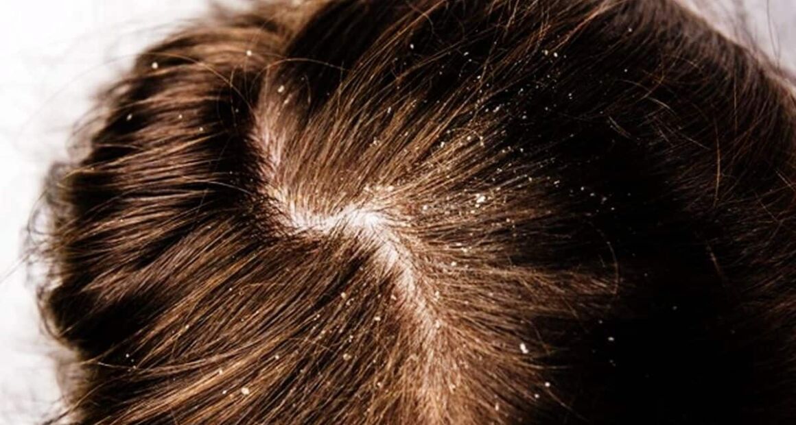 How To Get Rid Of Dandruff