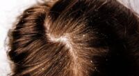 How To Get Rid Of Dandruff