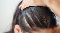 Bald Spots due to Hair Loss